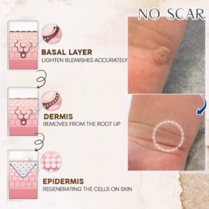 2Pcs Tags & Moles Remover