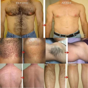 LolaLife- Semi-Permanent Hair Removal Spray