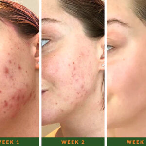 NEVU Acne Spot Applicator