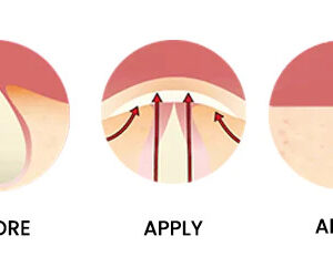 NEVU Acne Spot Applicator