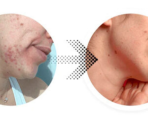 NEVU Acne Spot Applicator