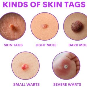 Organic SkinTag Solution