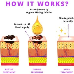 Organic SkinTag Solution