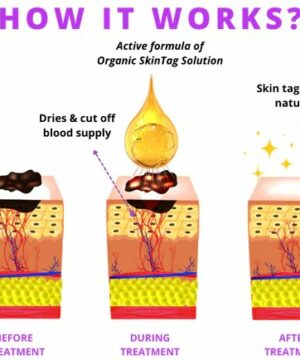 Organic SkinTag Solution