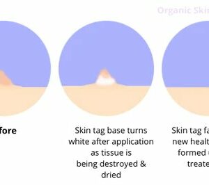 Organic SkinTag Solution