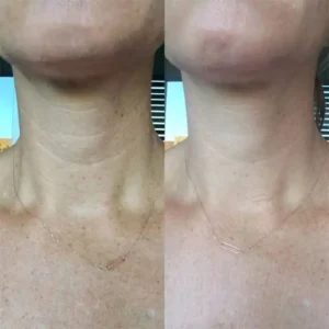 Reusable Silicone Patches