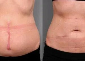 Scar MD® Silicone Scar Gel