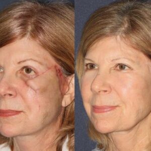 Scar MD® Silicone Scar Gel