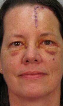 Scar MD® Silicone Scar Gel