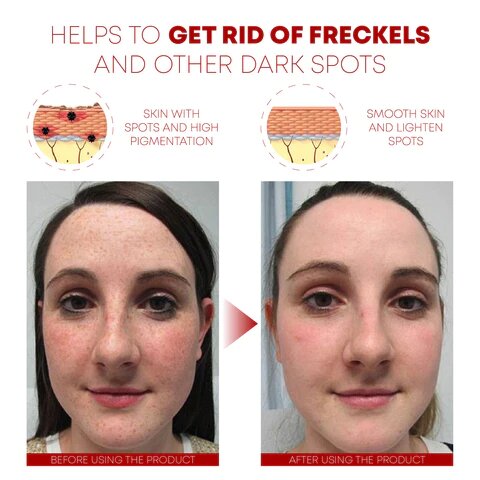 Spot Whitening Herbal Freckle Cream