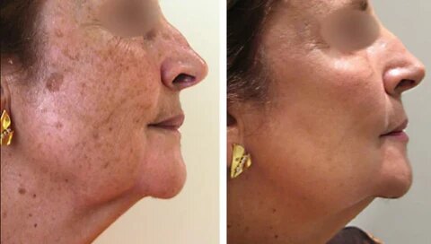 Spot Whitening Herbal Freckle Cream