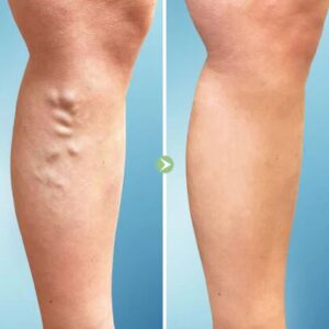 VeinDoctor Varicose Treatment Soap