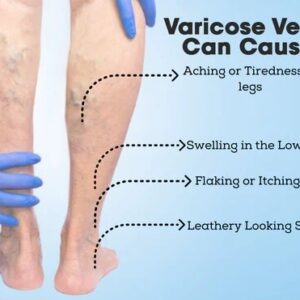 VeinDoctor Varicose Treatment Soap
