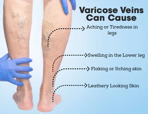 VeinDoctor Varicose Treatment Soap