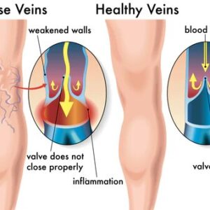 VeinDoctor Varicose Treatment Soap