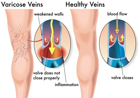 VeinDoctor Varicose Treatment Soap