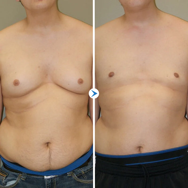 GynoOut Chest Tightening Spray