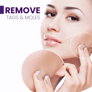 Alternative view of Sheva Spot Pigmentation Removal Pen