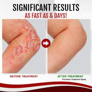 Alternative view of South Moon™ Psoriasis Treatment Spray