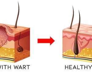 Wartoff Removal Ointmenta