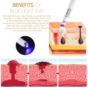 Alternative view of Akemi WartRemover LightTherapie Professional Kit