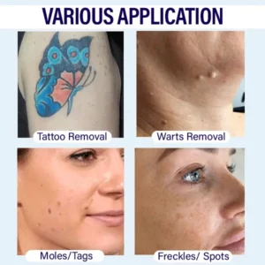 Alternative view of CalmSkin™ Spots Removal Pen