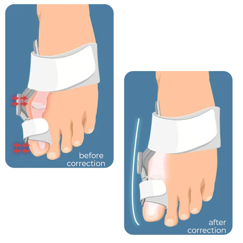 JointTech Anti Bunion Adjustable Corrector - Image 5