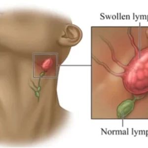 Alternative view of Lymph Detoxification Ginger Oil