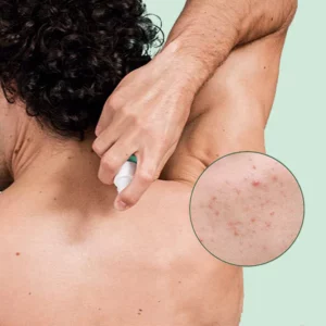 Alternative view of MEDix™ Back Acne Treatment Spray
