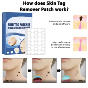 Alternative view of MaxPerformance Skin Tag Remover Patch