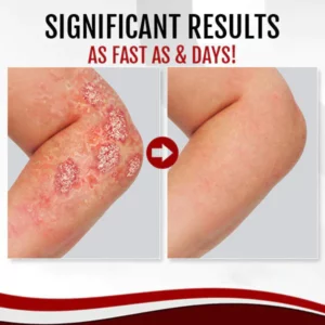 Alternative view of Mory™ Moisturizing Psoriasis Soap