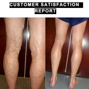 Alternative view of ReduceFast™ Mugwort Acupressure Detoxing&Shaping Knee Pads
