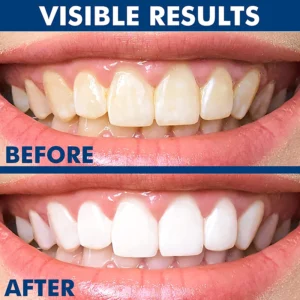 Alternative view of Tohcare™ Instant Teeth-Whitening Pen