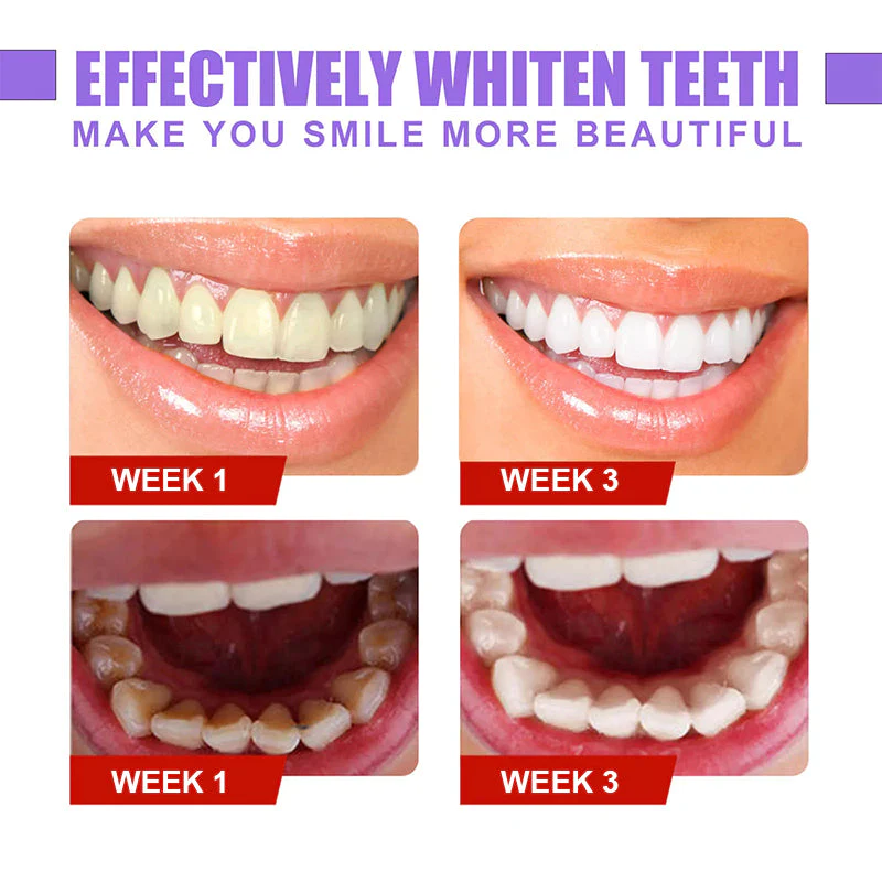v34™ Dental Color Corrector - Dental Restoration Gel - Image 5