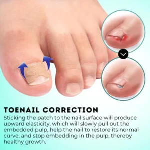 Alternative view of HealPatch™ Ingrown Toenail Corrector