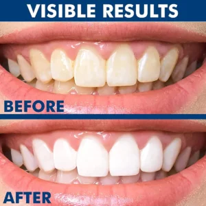 Alternative view of IonicWhite™ Teeth Whitening Essence