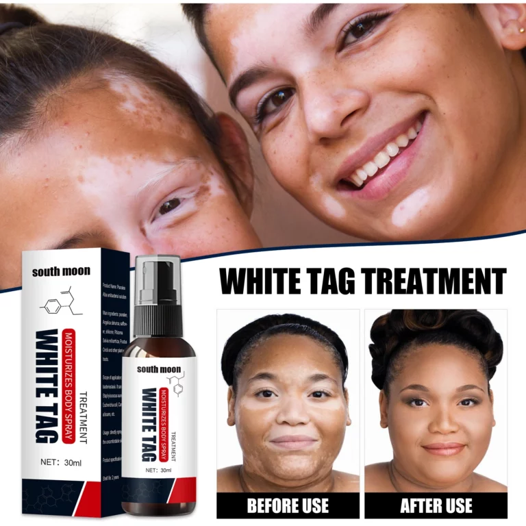 Kolmax™ Spray për lehtësimin e Vitiligos