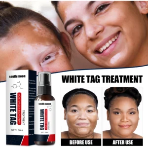 Kolmax™ Vitiligo Relief Spray