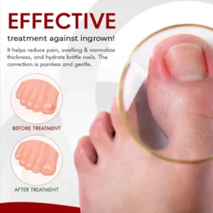 Alternative view of NailCare™ Ingrown Relief Oil