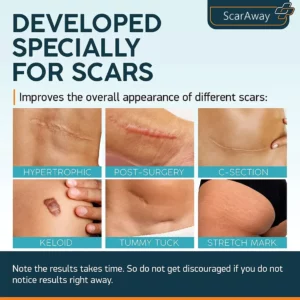 Alternative view of PROScarAway® 100% Advanced Scar Gel