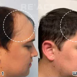 Alternative view of Re:ACT Exalted Minoxi Roll-On Hair Treatment
