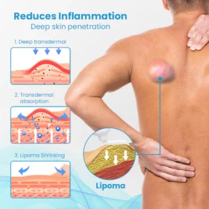 Alternative view of HEALumps™ Lipoma Treatment Ointment