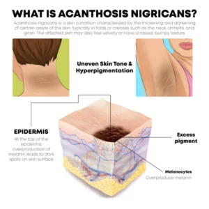 Alternative view of ATTDX AcanthosisNigricans Treatment Oil