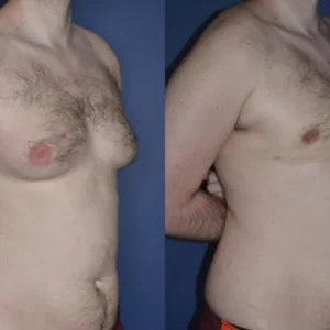ChestX Gynecomastia Reduction Spray