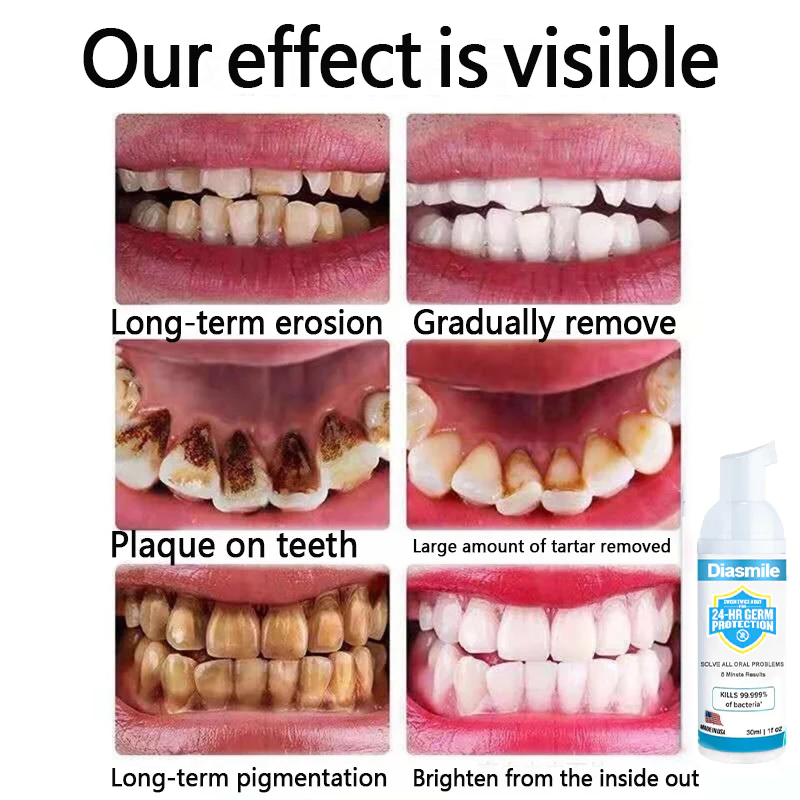 Diasmile™ Pure Herbal Super Whitening Teeth & Mouth Repair Foam
