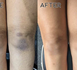 Fivfivgo™ Acanthosis Nigricans Therapy Oil