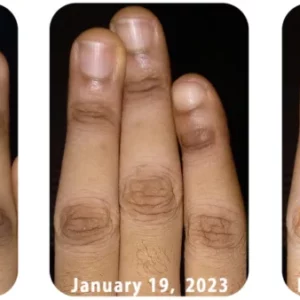 GFOUK™ AcanthoGlow Therapy Cream