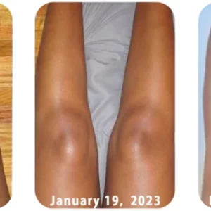 GFOUK™ AcanthoGlow Therapy Cream