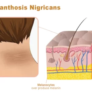 GFOUK™ AcanthoGlow Therapy Cream
