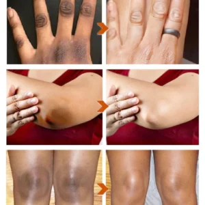 GFOUK™ AcanthoGlow Therapy Cream